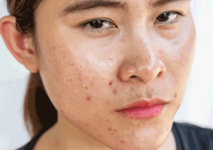 Skin Care Routine for Oily Skin