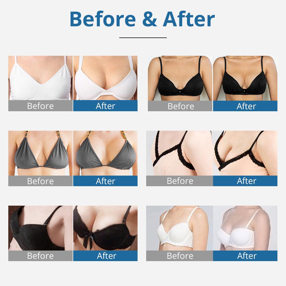 Buttom Lifting Breast Enlargement bbl Machine before & after