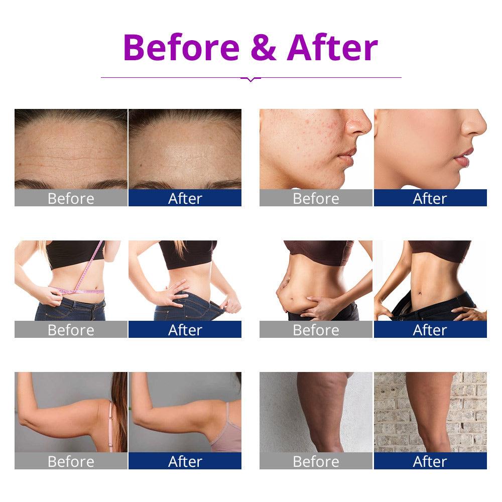 Cellulite Reduction Machine