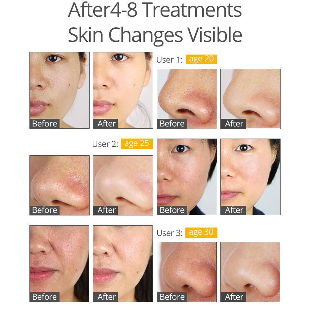 Diamond Microdermabrasion Facial Peel Beauty Machine