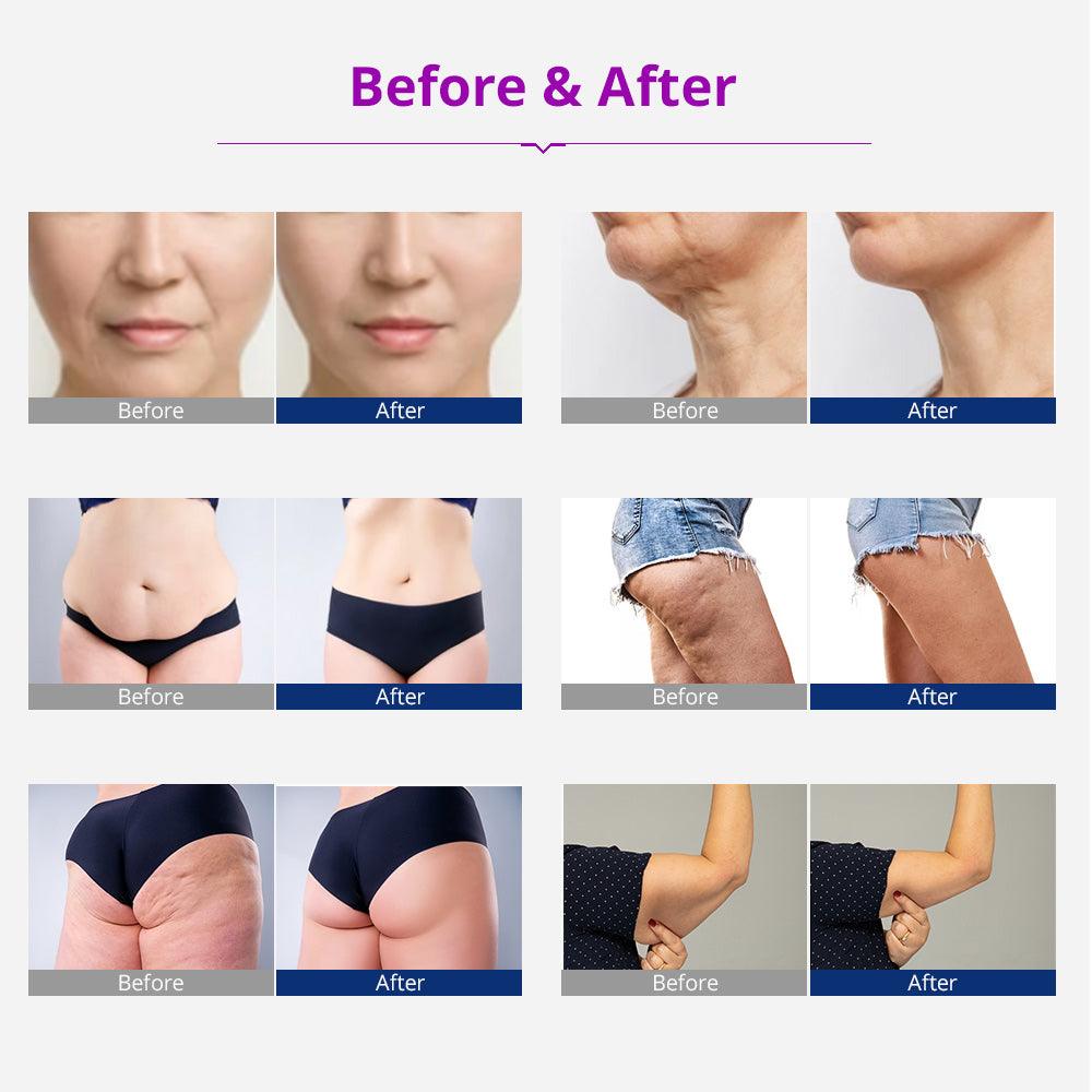 Radiofrequency Body Contouring Machine