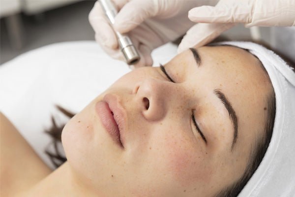What is Microdermabrasion and How Does It Work? - myChway UK