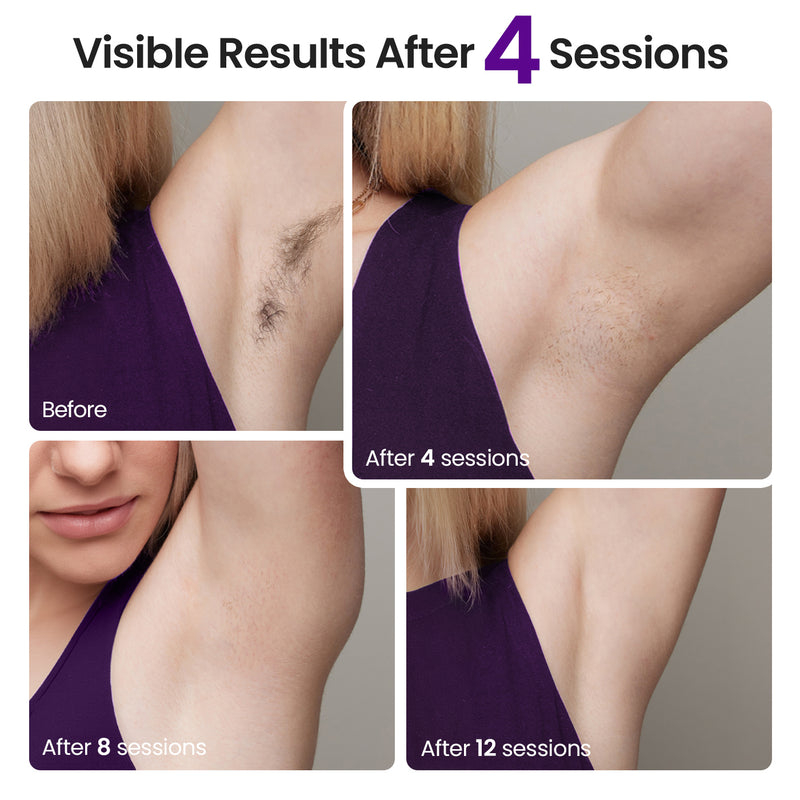 NAISIGOO IPL Hair Removal Device With Sapphire Ice Cooling