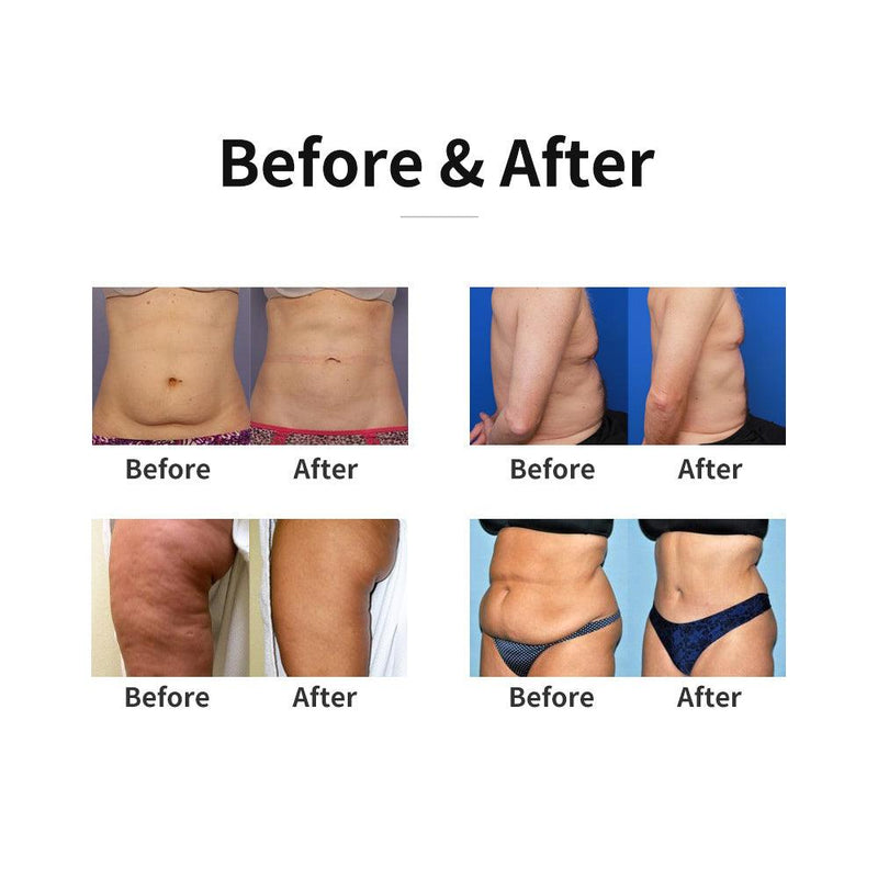 2D Handles Cryoskin Machine - myChway UK