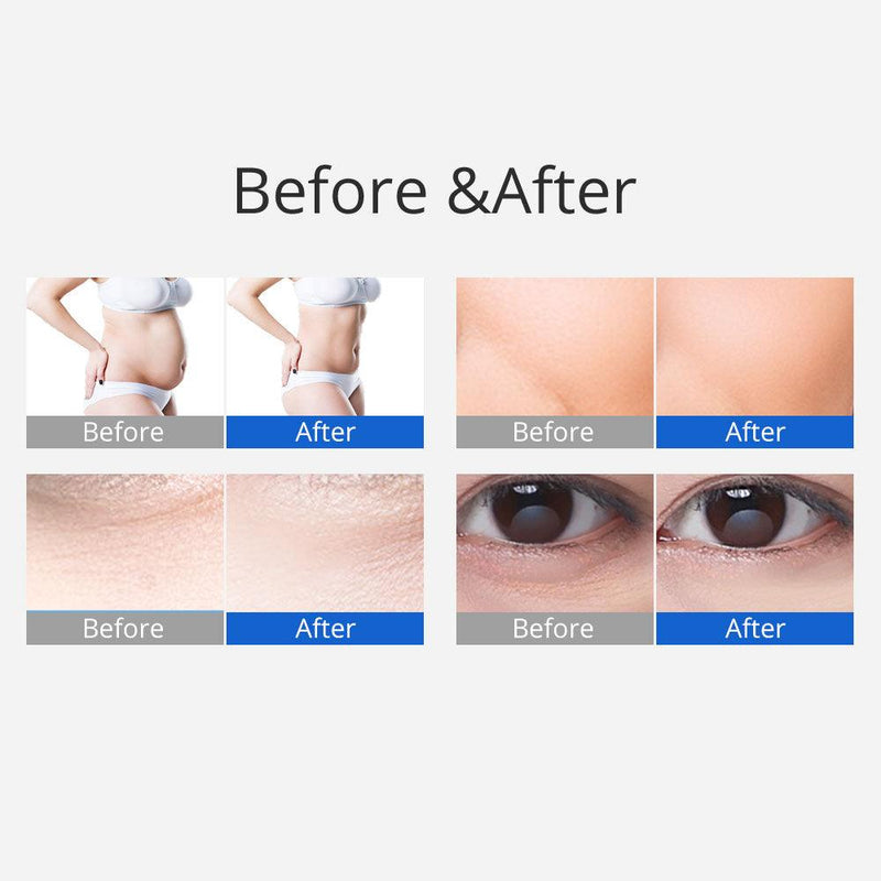 3 In 1 40K Ultrasonic Skin Tightening Machine - myChway UK