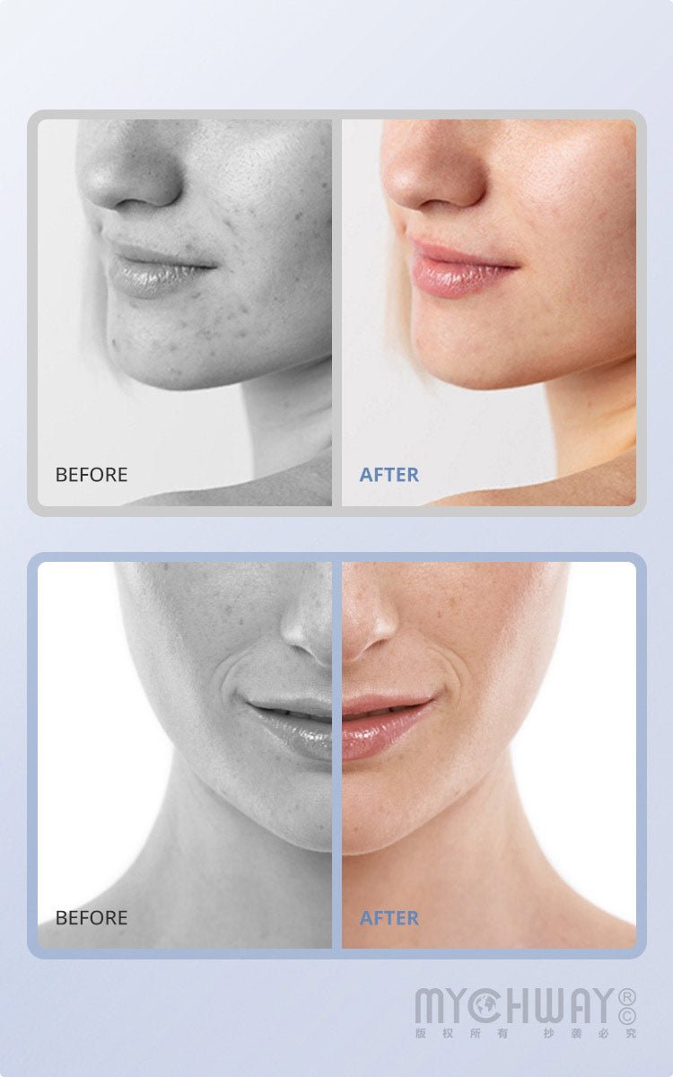 3 In 1 Diamond Microdermabrasion Machine For Exfoliation, Cleansing, Hydration - myChway UK