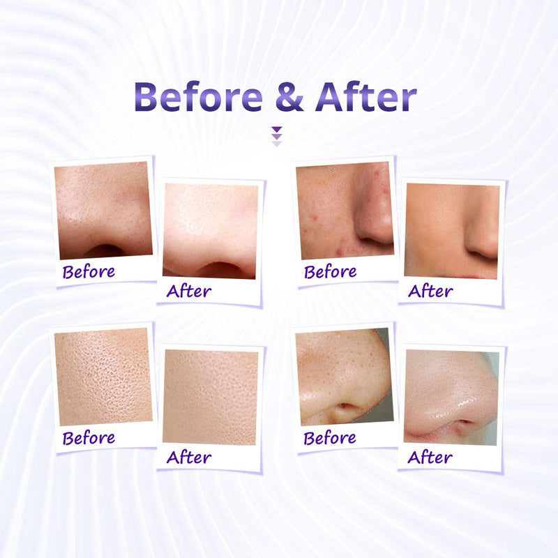 3 In 1 Diamond Microdermabrasion Skincare Machine - myChway UK