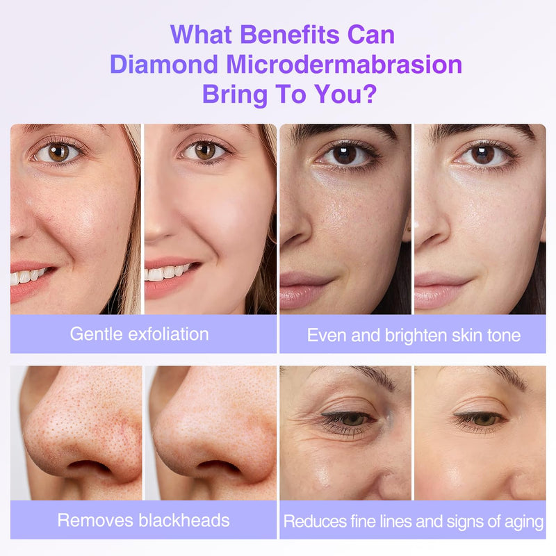 3 Wands & 9 Tips For Diamond Microdermabrasion Devices - myChway UK