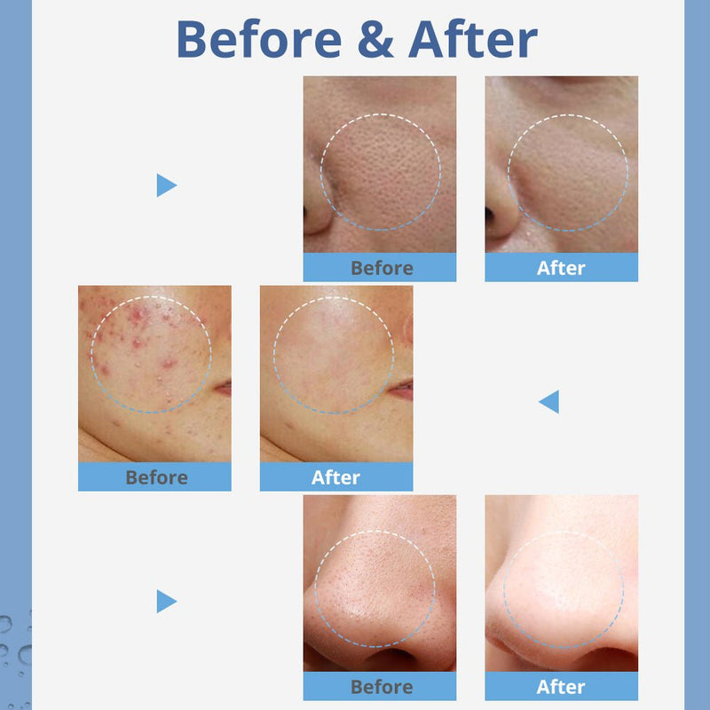 3in1 Hydro Microdermabrasion Machine For Skin Rejuvenation Cleansing Exfoliation - myChway UK
