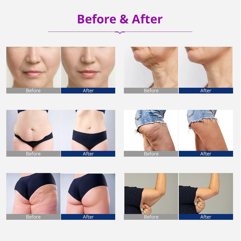 5 In 1 3 - polar Radiofrequency Body Contouring Machine - myChway UK