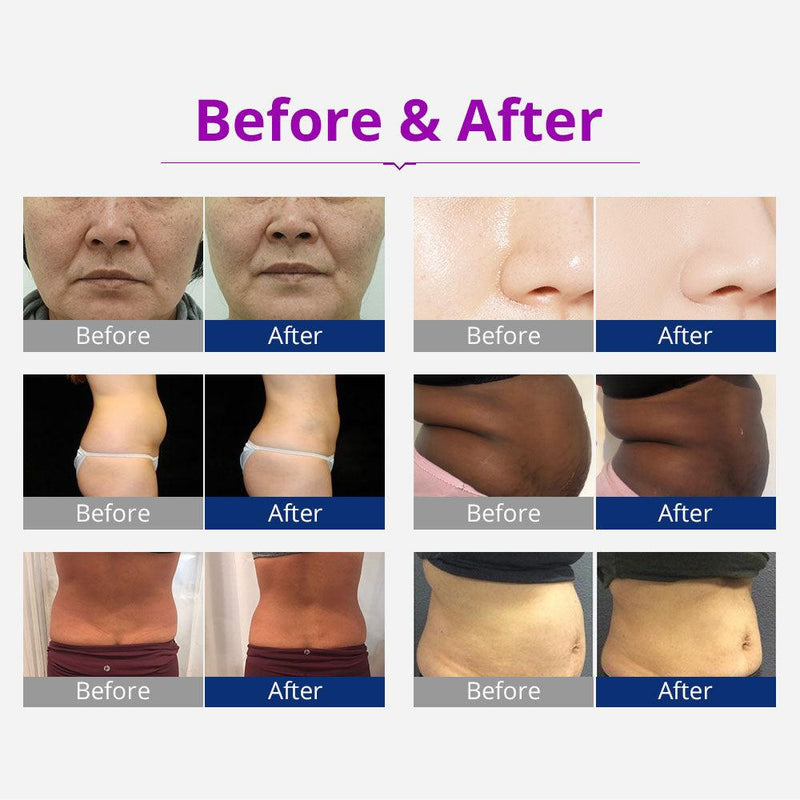 6 In 1 40K Ultrasonic Cavitation Device - myChway UK