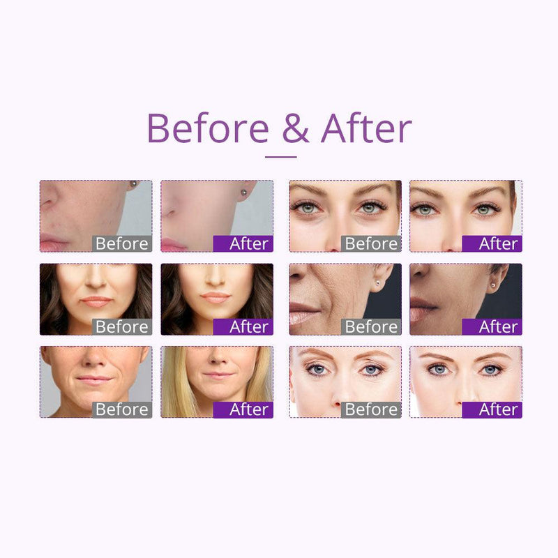 9 In 1 40K Vacuum Ultrasound Therapy Device - myChway UK