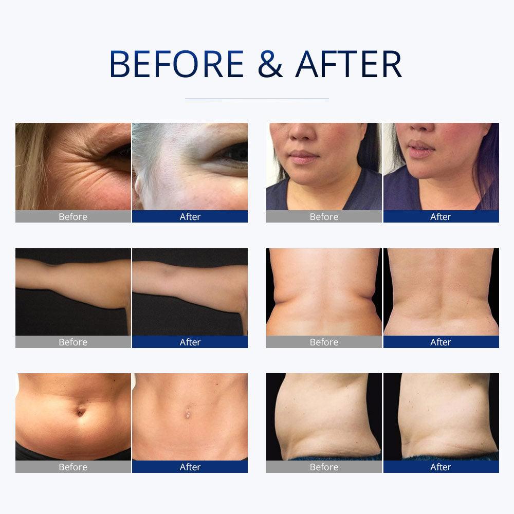 S Shape Body Sculpting Machine Handles used before and after