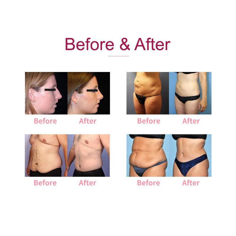 Cooling Coolsculpting Machine - myChway UK