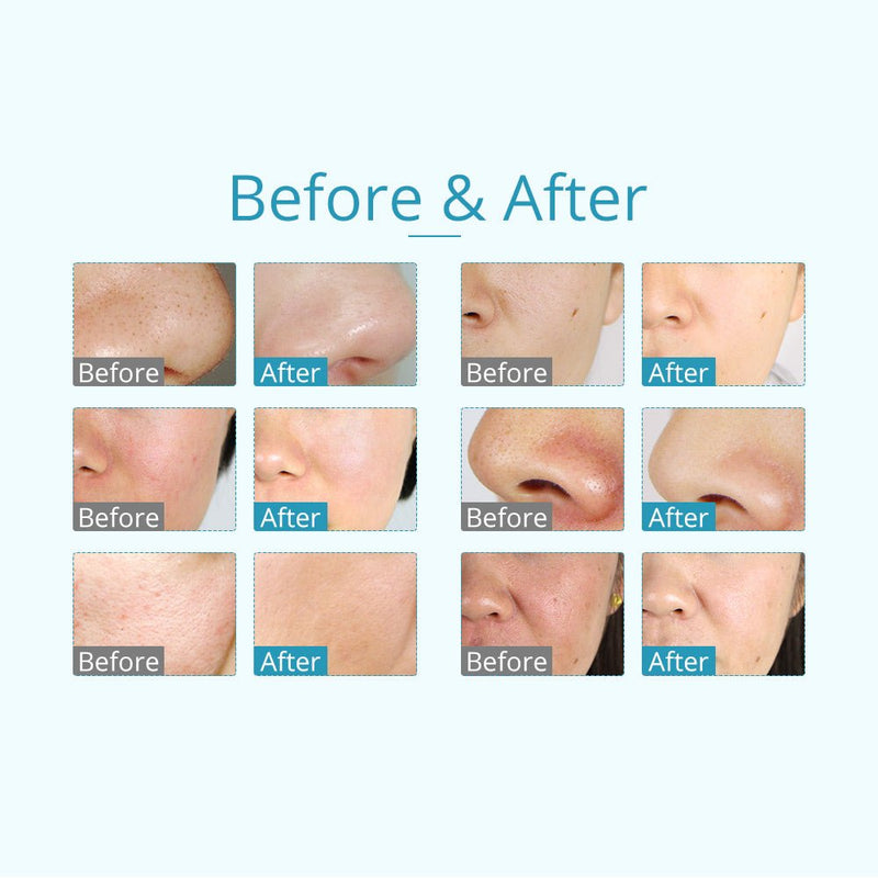 Facial Diamond Microdermabrasion Skin Firming Laser Eye Massage Beauty Equipment - myChway UK