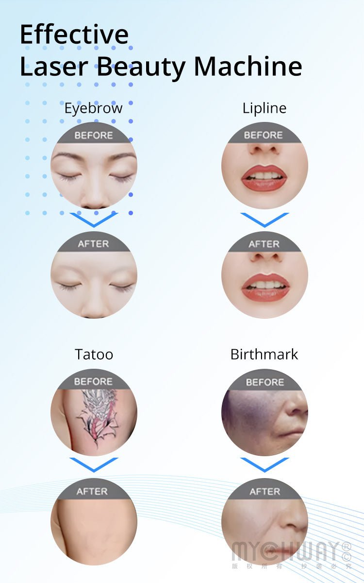 ND YAG Picosure Laser Beauty Machine Tattoo Removal Skin Whitening For Spa Use - myChway UK