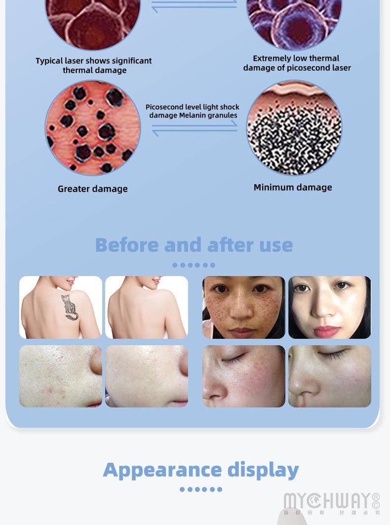 Professional Q Switch ND YAG LASER Tattoo Removal Eyebrow Callus Removal Machine - myChway UK
