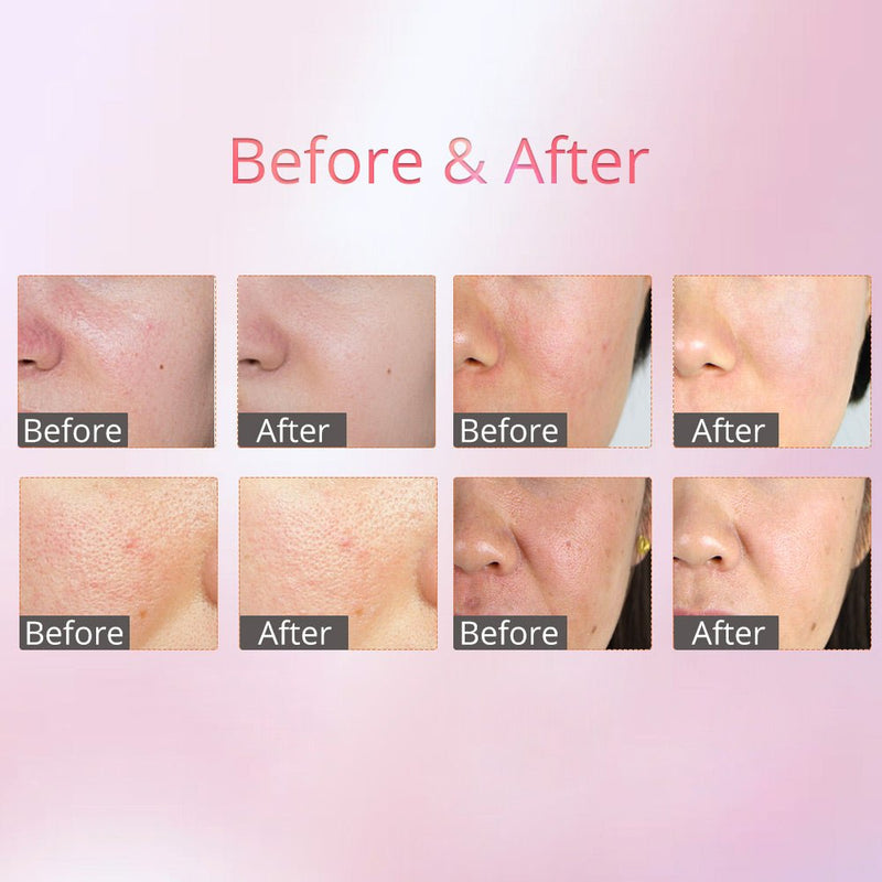 Professional Ultrasonic Skin Scrubber Machine For Skin Tightening Anti-Aging - myChway UK