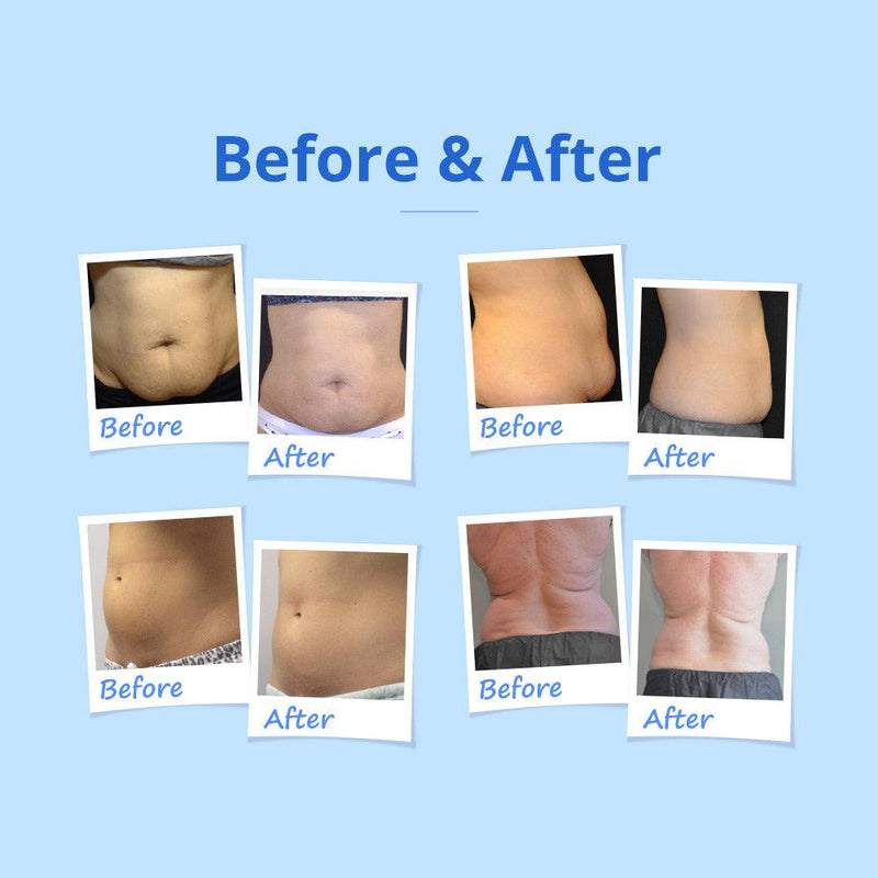 Two Handles Cryolipo Machine - myChway UK