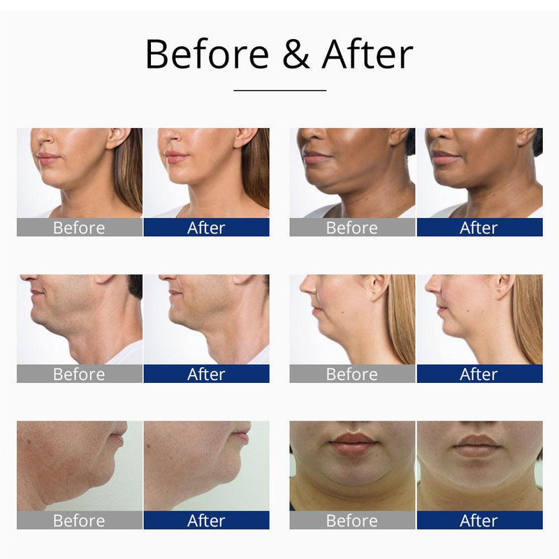 U Shape Double Chin Cryo Machine - myChway UK