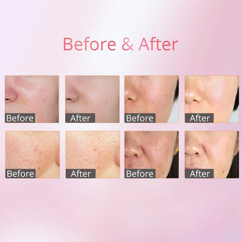 Professional Ultrasonic Skin Scrubber Machine For Skin Tightening Anti-Aging