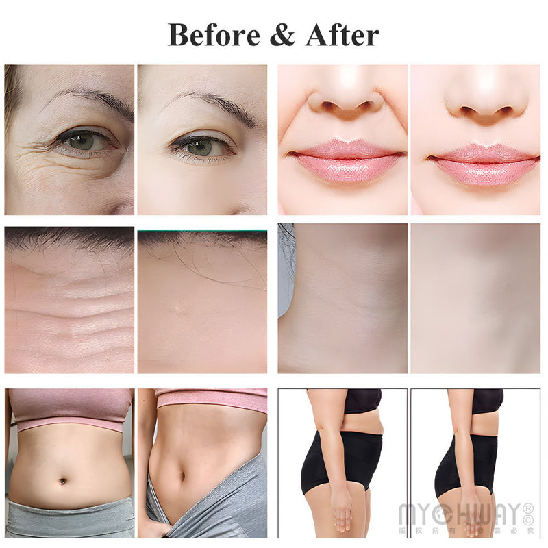 7D High Intensity Focused Ultrasound Machine Face Lifting Body Sculpting Device